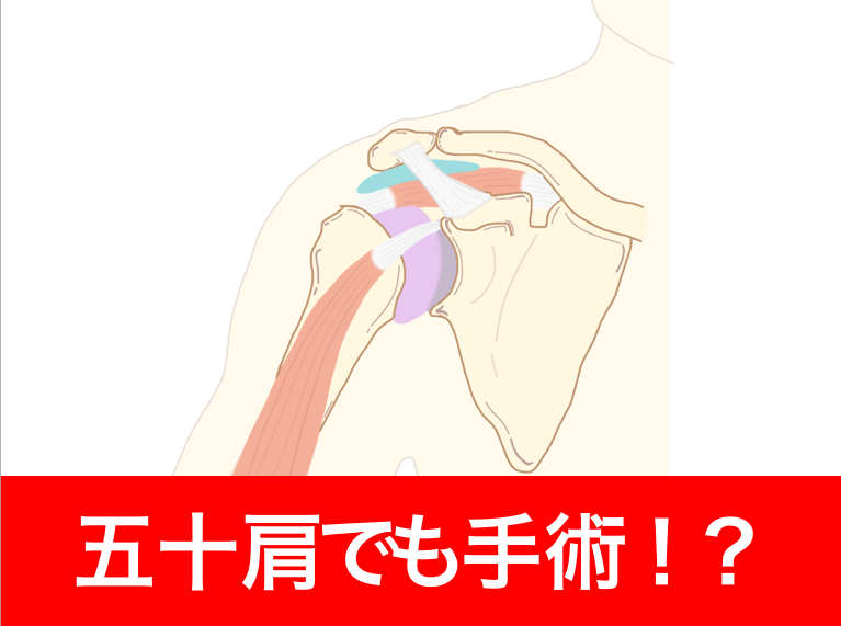 五十肩　手術